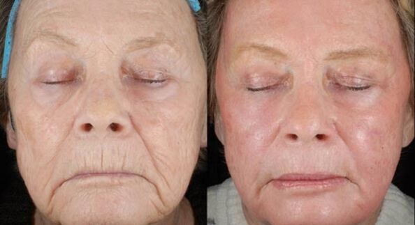 Before and after laser rejuvenation