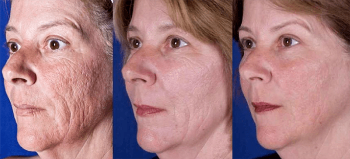 Results after laser facial skin rejuvenation process