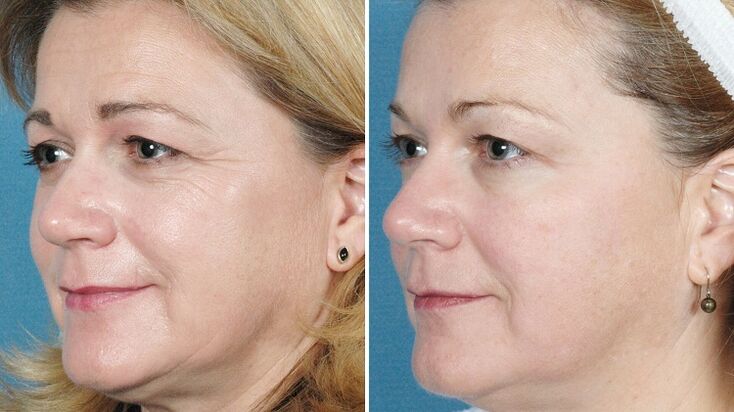Before and after hardware skin rejuvenation photos