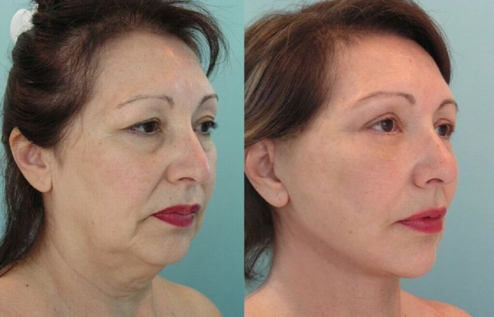 Before and after photo of skin rejuvenation